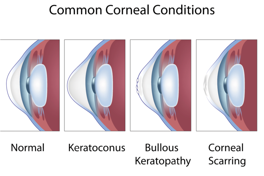 Corneal Diseases care in kharar