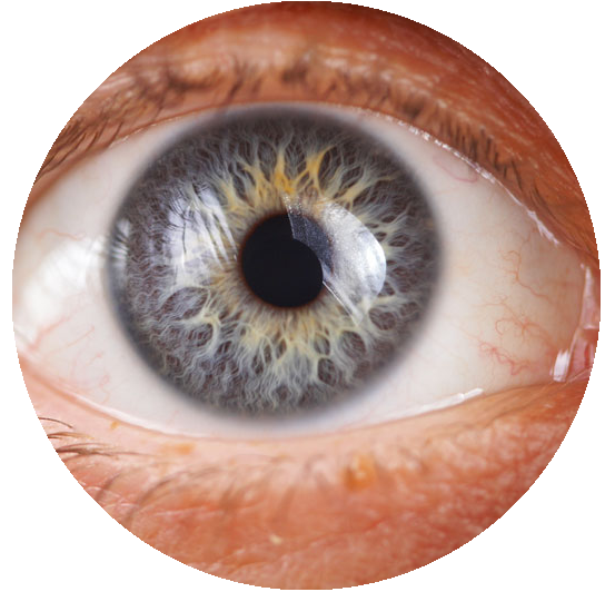 Glaucoma Treatment care in kharar